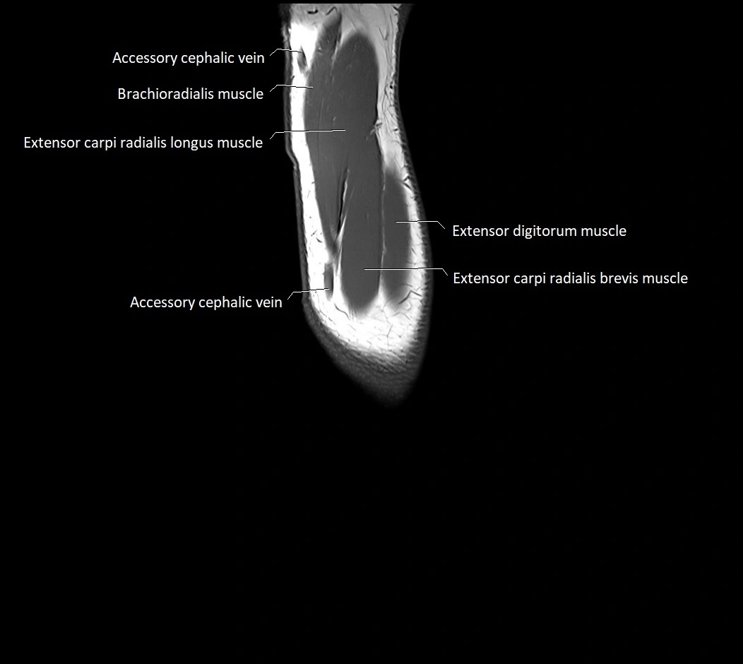 MRI 3T forearm sagittal labelled cross sectional anatomy image 5.webp